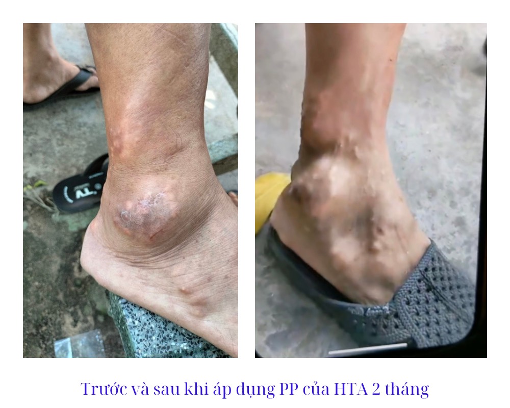 benh-nhan-gout-tien-trien-the-nao.jpg bệnh nhân gout