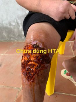 Sử dụng nước muối điện hóa HTA trong hỗ trợ điều trị vết thương hở