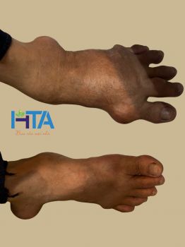Thảo dược kiềm hoá đa tầng HTA với người bệnh Gout